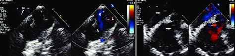 A Two Dimensional Transesophageal Echocardiographic Modified Upper Download Scientific