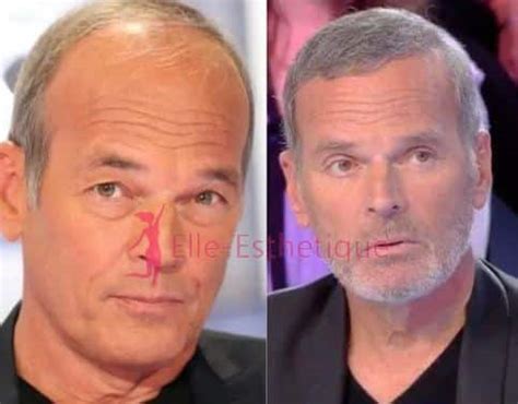 Laurent baffie Avant Après Chirurgie Vaut elle le Coup