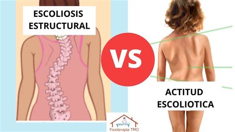 Escoliosis Causa Y Diferencia Entre Actitud Escoliotica Y Escoliosis