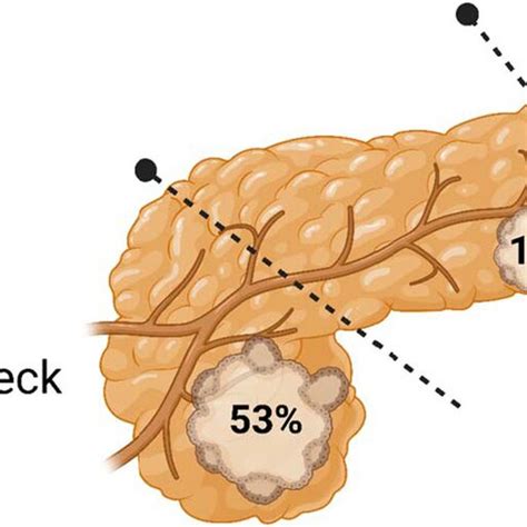 Image Depicting Location Of Pancreatic Adenocarcinoma Within The Download Scientific Diagram