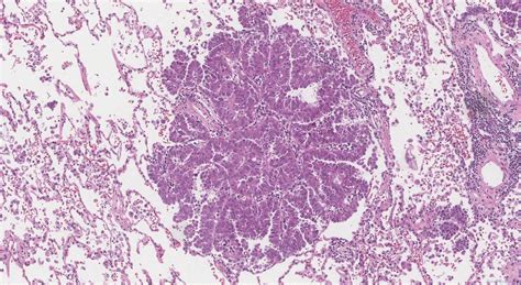 Adenocarcinoma Of The Lung Atlas Of Pathology