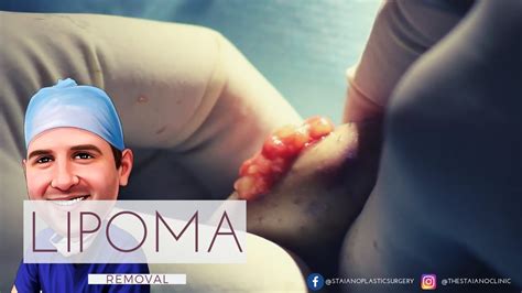 Lipoma Removal Youtube