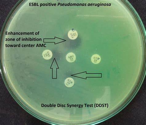 Double Disc Synergy Test Esbl Positive Pseudomonas Aeruginosa The