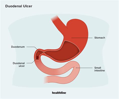 Pathology Duodenal Ulcer Kembara Xtra