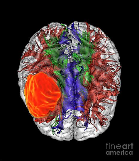 Glioblastoma Brain Cancer Photograph By Zephyr Science Photo Library