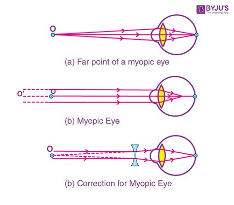 Defects of Vision And Their Correction - Myopia, Hypermetropia ...