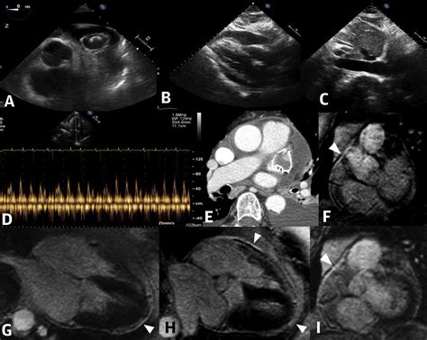 A Case Of Delayed Hemorrhagic Effusive Constrictive Pericarditis After