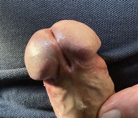 Hypospadias Cock 62 Pics Xhamster