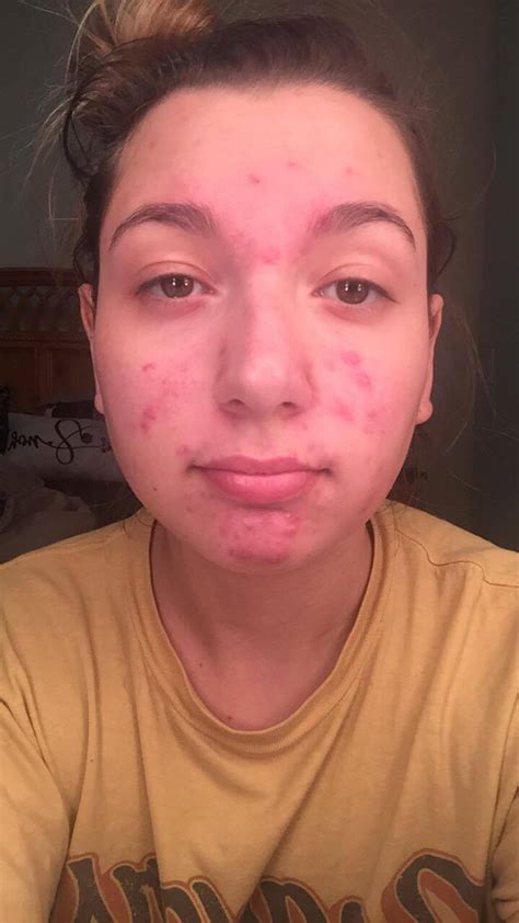 [Routine Help] Acne worsts it has ever been!! : r/SkincareAddiction