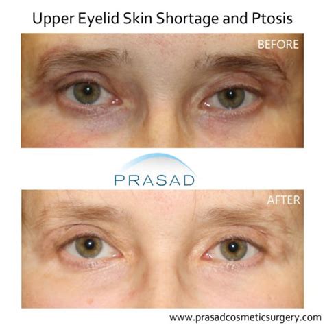 Can Upper Blepharoplasty Go Wrong Dr Prasad Blog