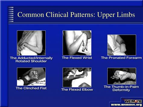 Ppt Spasticity Evaluation And Treatment Planning Powerpoint