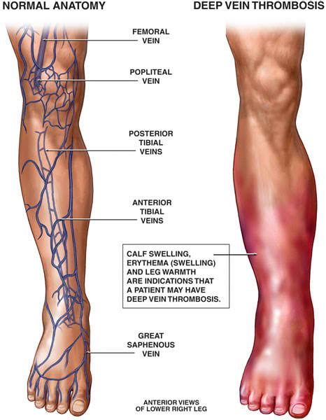 10 Deep Vein Thrombosis Dvt Facts