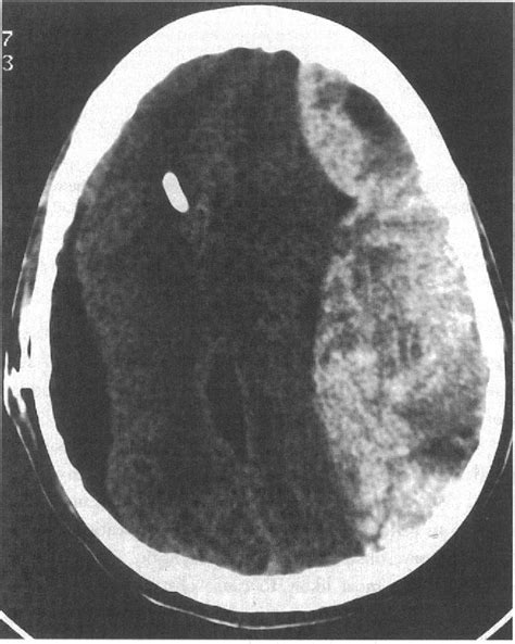 Figure 2 From Contralateral Extradural Haematoma After Insertion Of A