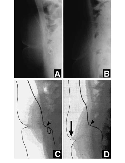 Case 3 Postoperative Abdominal Radiographs Lateral View Illustrating