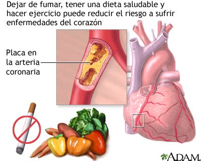 Prevenci N De La Enfermedad Card Aca Medlineplus Enciclopedia M Dica