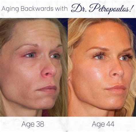 Botox Fillers Radio Frequency Skincare To Help This Patient Stay