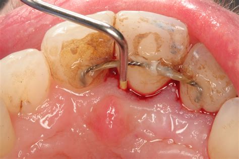 Abscessed Teeth Perio Peak