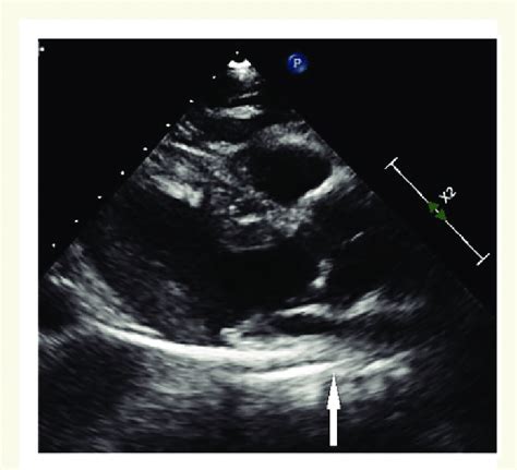 Transthoracic Echocardiogram Parasternal Long Axis View Showing