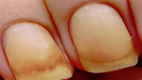 What Is Yellow Nail Syndrome Causes Symptoms Complications