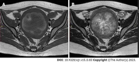 Magnetic Resonance Imaging Findings Of Spontaneous Pyomyoma In A