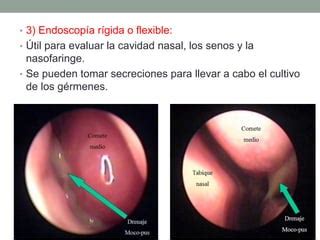 Rinosinusitis aguda y crónica PPT