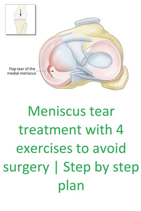 Meniscus Tear Treatment Torn Meniscus Exercises - vrogue.co
