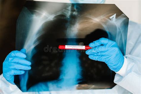 Doctor Specialist Pulmonary Medicine Holding Radiological Chest X Ray