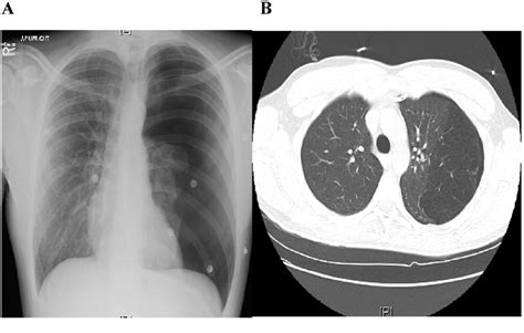 An Atypical Case Of Congenital Lobar Emphysema In An Adult Non Smoker