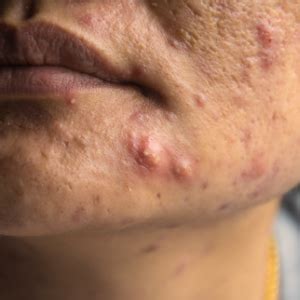 Acne Cyst Chin