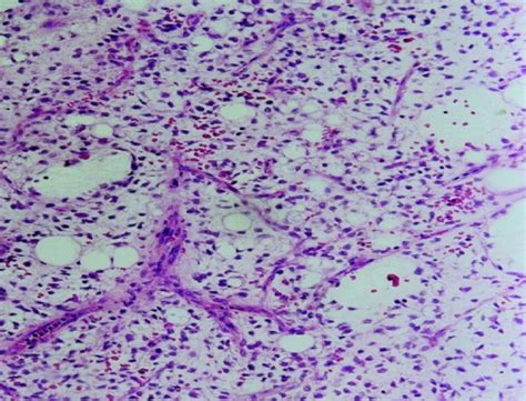 Histology Slide Of Myxoid Liposarcoma Showing Lipoblasts And