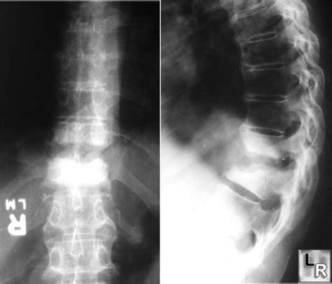 Learning Radiology Discitis Osteomyelitis Spine Disc Disk