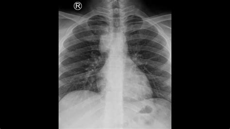 Mediastinal Lymphadenopathy- cTBNA - Dr Rajdeep Dhandhukiya - YouTube