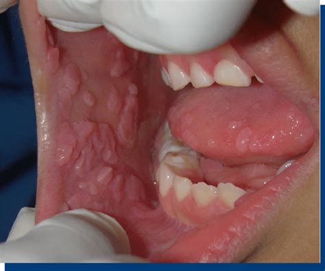 Multiple Papules Located In The Buccal Mucosa Labial And The Anterior