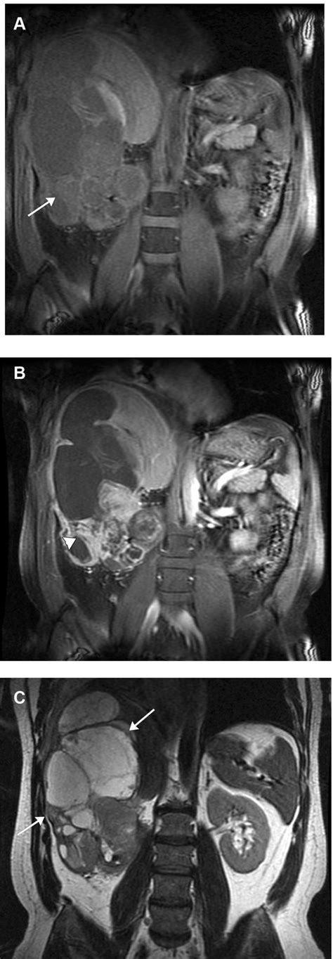 A Undifferentiated Pleomorphic Sarcoma Formerly Malignant Fibrous