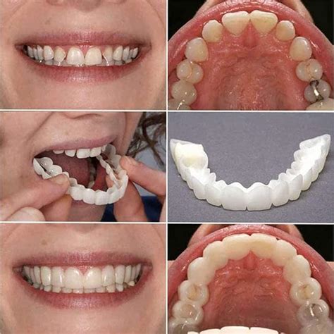 6 Paar Veneers Snap In Zähne Gefälschte Zahn Lächeln Gezahnt Zahnersatz