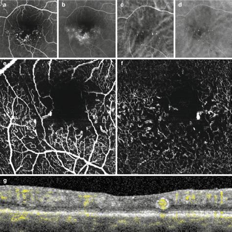 Fig Multimodal Imaging Of Type I High Resolution Imaging