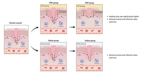 The Efficiency And Safety Of Platelet Rich Plasma Dressing In The