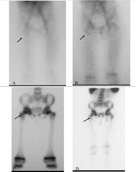 Osteomyelitis Concise Medical Knowledge