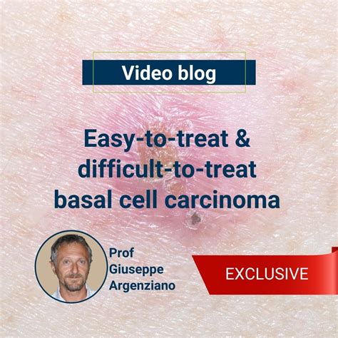 8 Min Watch Easy To Treat And Difficult To Treat Basal Cell Carcinoma