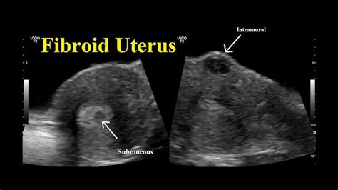 Anteflexed Uterus Ultrasound