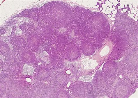 Resected Lymph Nodes Showing Reactive Lymphadenitis He ×10