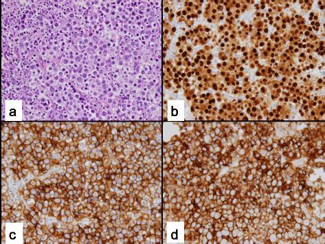 Dysgerminoma arising within Gonadal Dysgenesis: a Dysgerminoma with... | Download Scientific Diagram