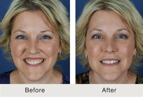 Before And After Botox For Gummy Smile Carolina Facial Plastics