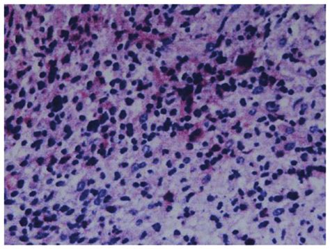 Biopsy sample demonstrating that cells with the typical morphology of... | Download Scientific ...