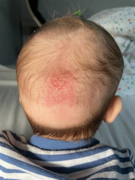 What You Need To Know About Cradle Cap Frisco Pediatrician Entirely