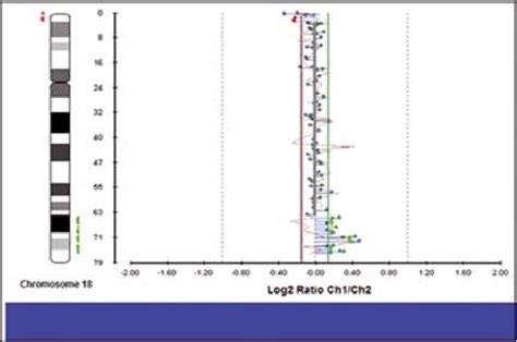 The Partial Array Cgh Revealing The 18p Deletion And The 18q Download Scientific Diagram