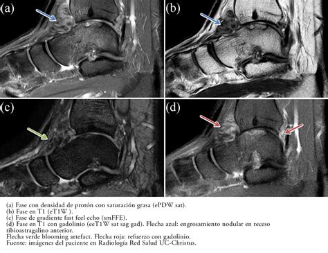 Tratamiento artroscópico de sinovitis villonodular pigmentada de