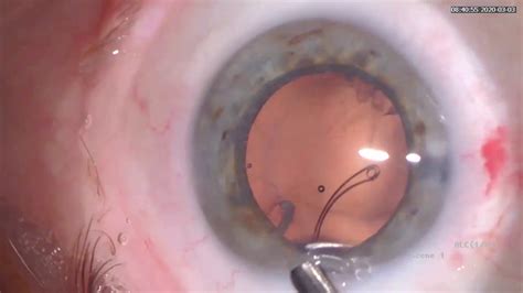 Mature Cataract Surgery In Pseudoexfoliation Pxfpex With Capsular