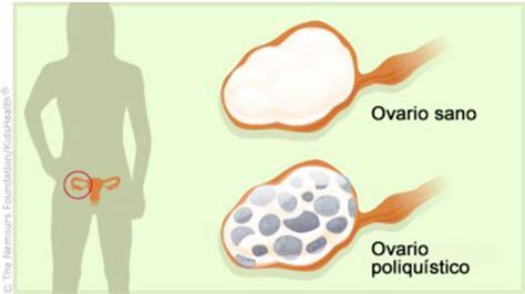 Quistes En Los Ovarios Tratamiento En Valencia
