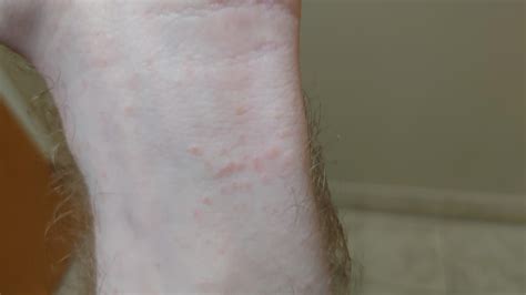 Rash On Wrist Doesnt Itch Much And Looks Like Clear Bumps With A Center This Isnt Scabies